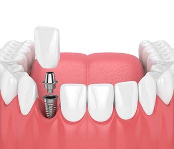 Zirconia implants side effects