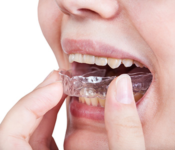 Mouthguard for teeth grinding