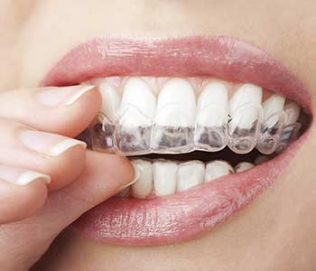 Braces for Adults in Brookline area