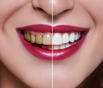 Dr. Stan Kovtun prescribes effective whitening you can apply from the comfort of home.