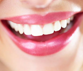 Professional vs over the counter teeth whitening in Brookline