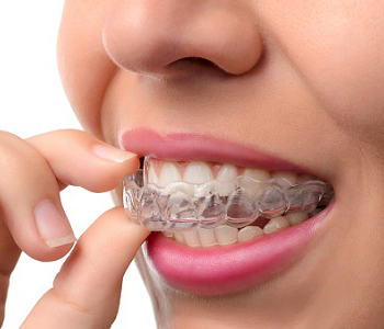 What are invisible braces?