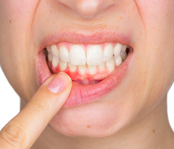 Why Gum Disease Needs to be Treated in Brookline area
