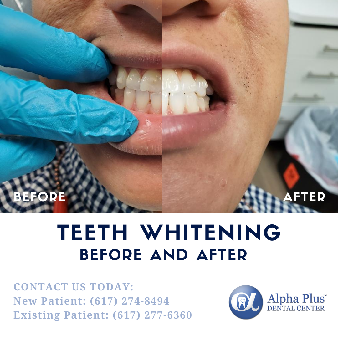 Teeth Whitening Before And After By Brookline Cosmetic Dentist