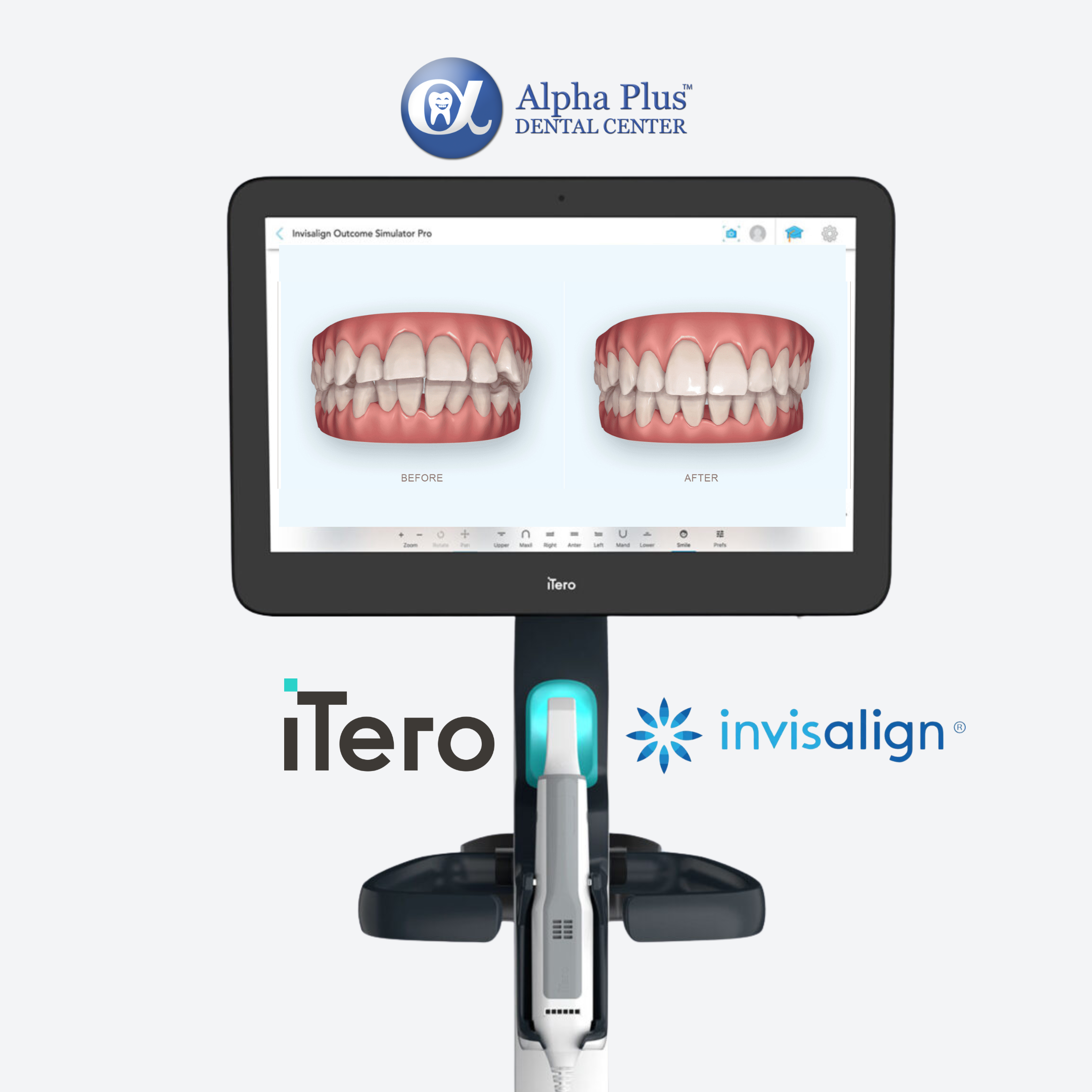 iTero scanner cosmetic dentistry, before after photo