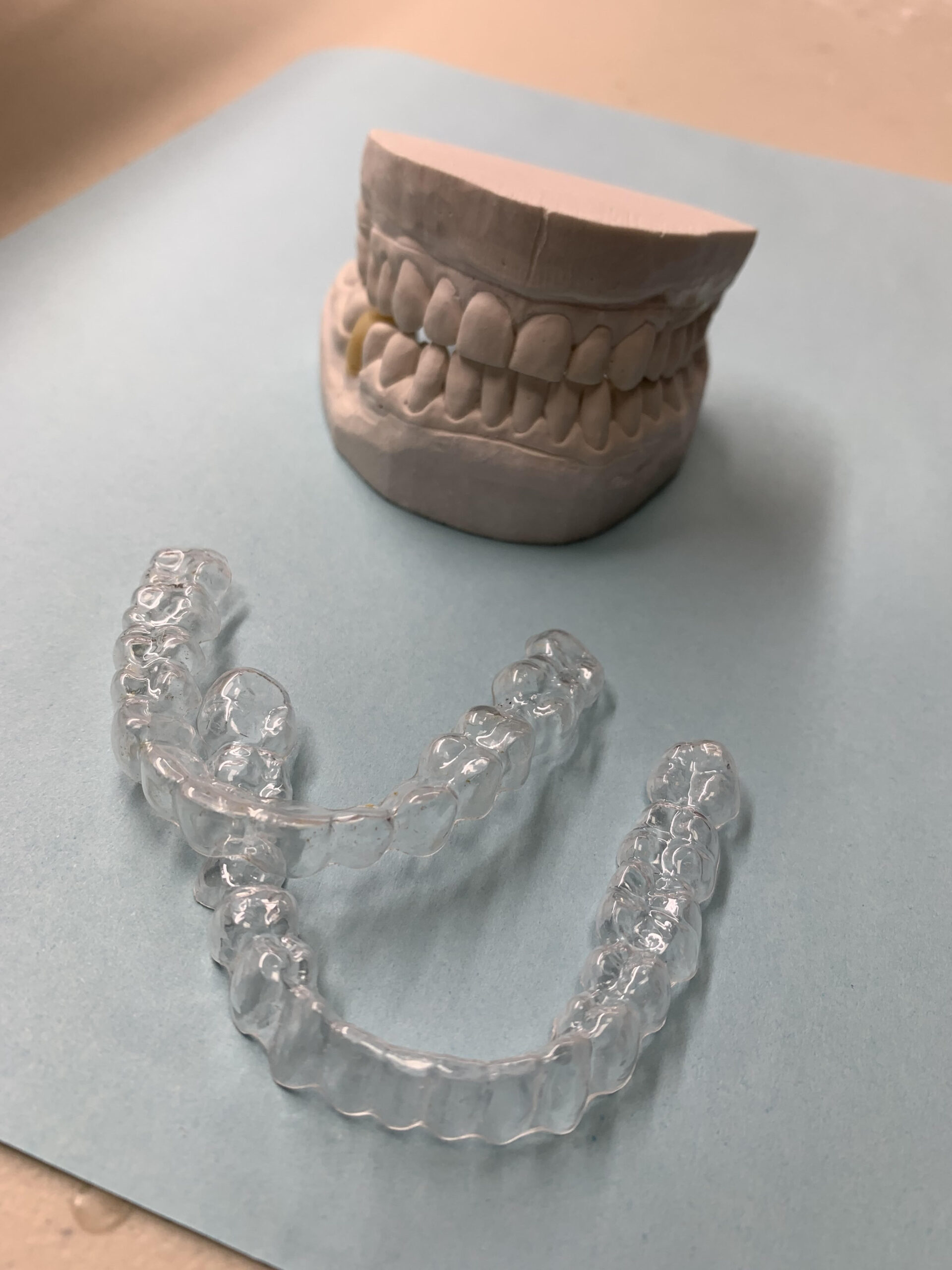 A dental model of upper and lower teeth sits on a light blue surface, with a pair of clear aligners or retainers placed in front of it. The aligners are transparent and molded to fit perfectly over the teeth. The setup highlights orthodontic treatment options for teeth alignment and retention. The lighting is soft, emphasizing the clarity of the aligners and the details of the dental model.